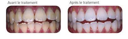 avant apres eclaircissement toutes les dents