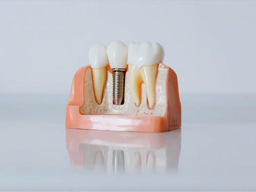 implant dentaire dentiste
